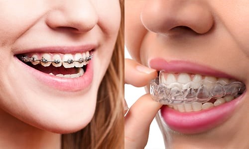 Orthodontic Treatment (Braces / Aligners)